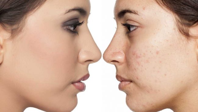 get rid of acne scars